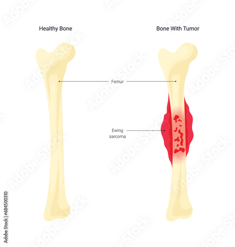 Bone Cancer Disease Illustration