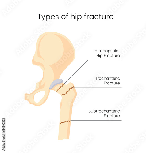 Types of Hip Fracture Illustration