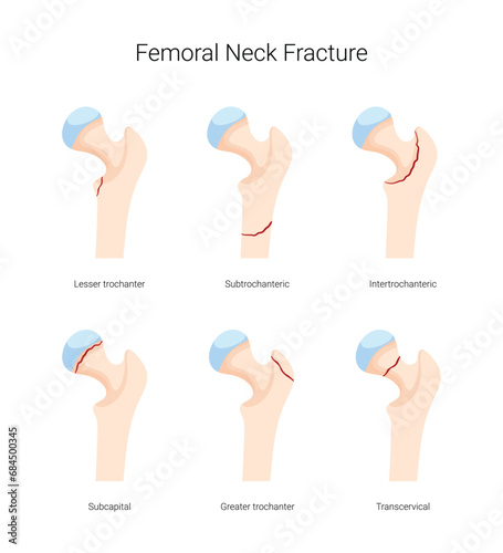 Types of Femoral Neck Fracture Disease