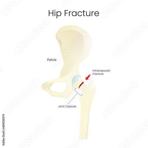 Hip Fracture Disease Illustration