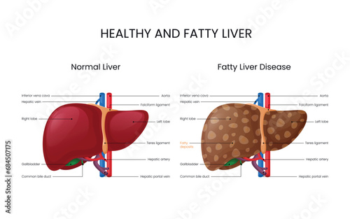 Normal Liver And Fatty Liver Disease photo