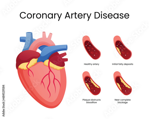 Stages of Coronary Artery Disease