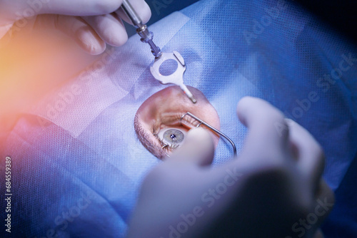 Process laser vision correction, lasik treatment. Doctor use equipment for fixing eyeball, patient under sterile cover