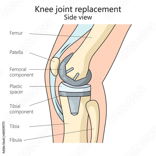 knee joint replacement structure diagram hand drawn schematic raster illustration. Medical science educational illustration