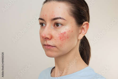 young Caucasian woman suffering from rosacea on her face in the acute stage. Dermatological problems.  isolated on a beige background. skin chronic disease photo