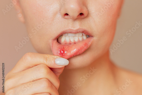 a close-up of the face of a young woman who turns her lip with her finger shows an ulcer of stomatitis in the acute stage on the mucous membrane of the mouth. photo