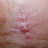 Scar with threads after removal of skin cancer on the head