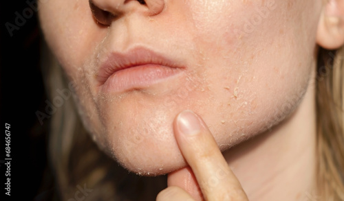 The woman skin flakes off at the mouth. Dry skin. Face skin irritation after peeling, after cold windy weather. Dark background, view by profile photo