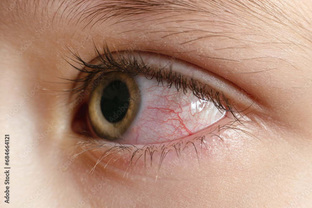 Closeup irritated infected red bloodshot eyes, conjunctivitis Closeup irritated infected red bloodshot eyes, conjunctivitis