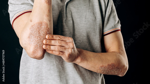 Acute psoriasis on the elbows is an autoimmune incurable dermatological skin disease. A large red, inflamed, flaky rash on the elbows. Joints affected by psoriatic arthritis photo