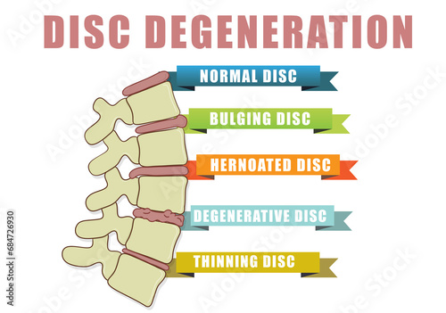 Canvas-taulu Disc degeneration diagram with condition exampes - bulging, hernoated, degenerative and thinning disc