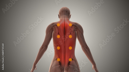 Myofascial pain syndrome or chronic pain disorder photo