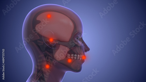 Photos Referred pain from muscle trigger points in the masticatory and neck-shoulder mu