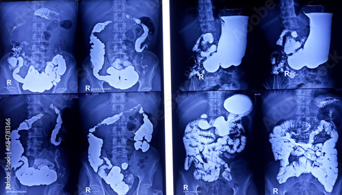 Barium meal and follow through examination x-ray. showing digestive system. most part of stomach, large intestine such as transverse colon, sigmoid colon and rectum. Normal findings. photo