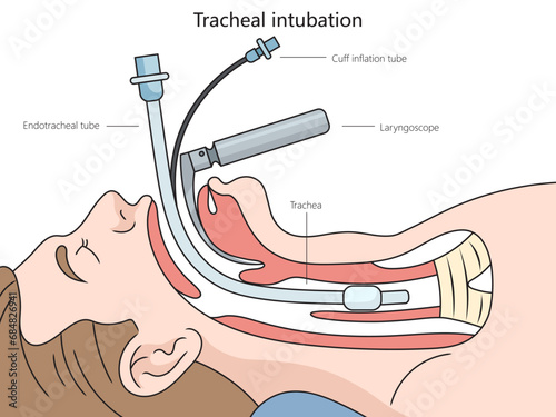 Tracheal intubation structure diagram hand drawn schematic vector illustration. Medical science educational illustration photo