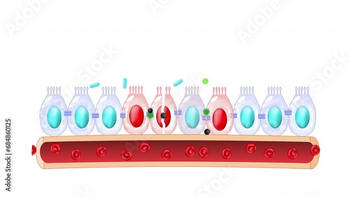 Leaky gut Syndrome. difference between Healthy cells, and inflamed intestinal cells. Gut barrier dysfunction. Intestinal inflammation. 2d animation