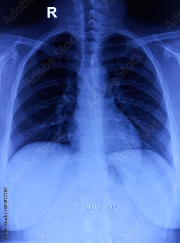 CXR (Chest X-Ray) PA view. Cervical ribs, normal findings. photo