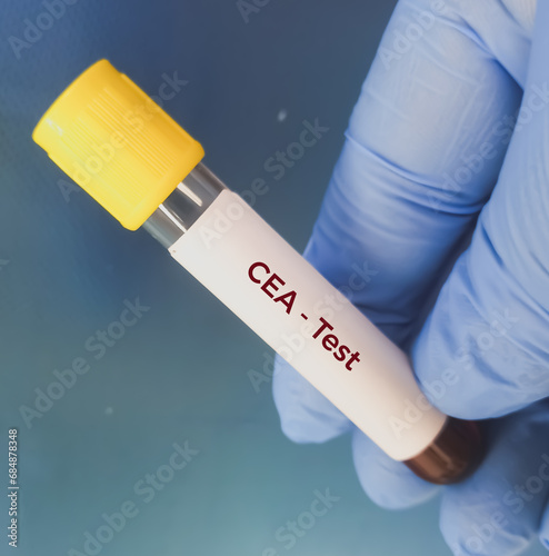Blood sample for CEA (carcinoembryonic antigen) test, tumor marker for Colon cancer. Colorectal cancer. photo
