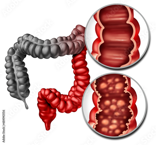 Ulcerative colitis as an inflammatory intestine with healthy and ulcerated inner bowel lining disease with a human rectum and colon as a digestive system and digestion concept with inflamed large inte photo