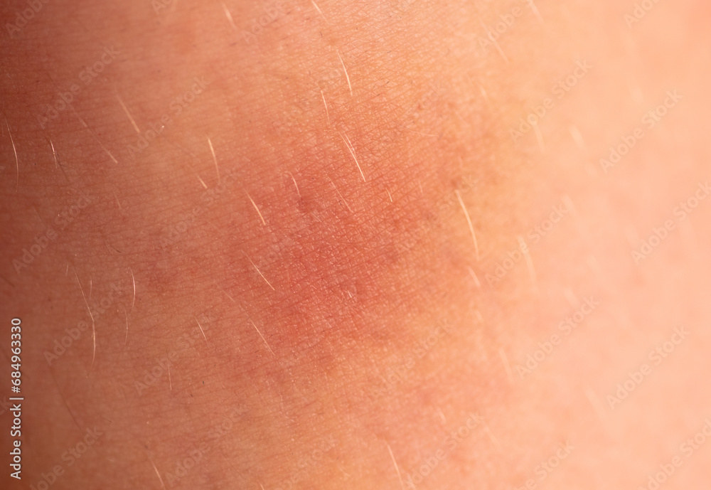 Close-up of a bruise on the skin. Macro - obrazy, fototapety, plakaty 