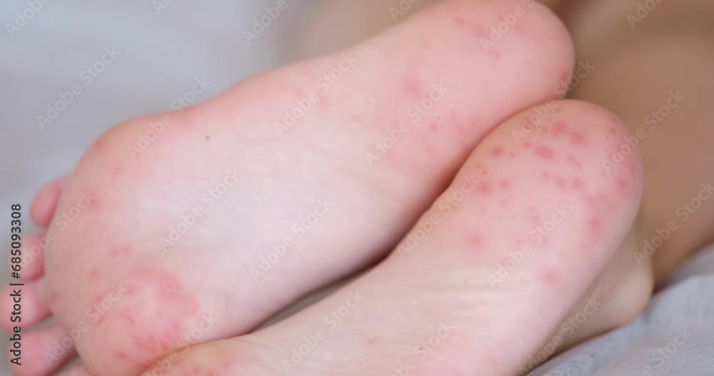 Feet of child with red allergic spots dots on foot. Enterovirus coxsackie skin red rash insect bites or covid infection Feet of child with red allergic spots dots on foot. Enterovirus coxsackie skin red rash insect bites or covid infection