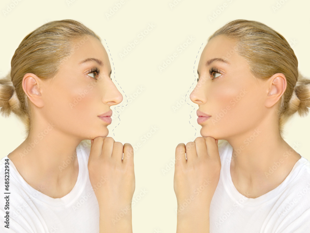 Rhinoplasty.Before and after. process of reconstructing nose Rhinoplasty.Before and after. process of reconstructing nose