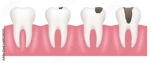 Healthy teeth and teeth with caries. Vector clipart.