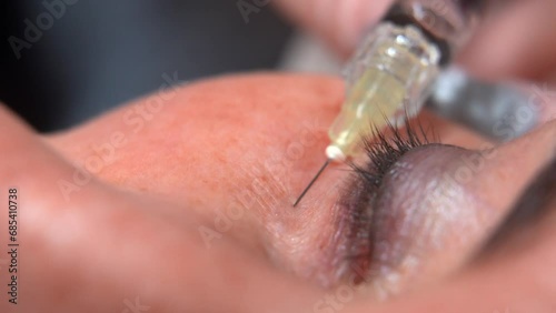 Cosmetologist doctor making multiple injections biorevitalization in woman face skin under eye, closeup shot. Mesotherapy, beauty concept