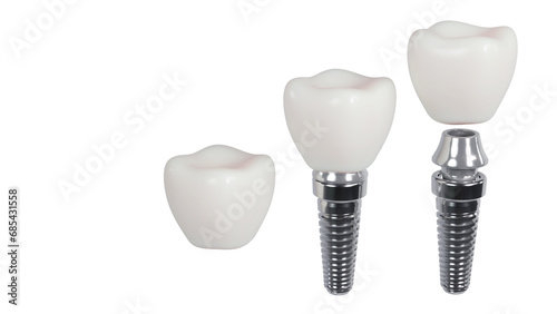 3D rendering of tooth implants with ceramic crowns on a white background, Modern dental surgery concept