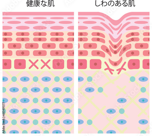 健康な肌としわのある肌の断面図
