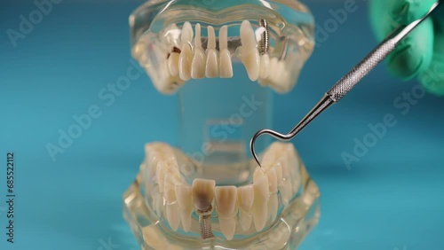 A doctor dentist uses a periodontal probe to examine teeth for the presence of caries, tartar and the condition of the tooth root on a model of the patient s jaw. Concept of treatment and prevention photo