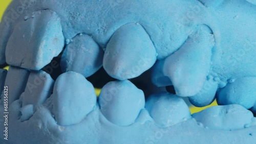 Not Straight and crooked teeth on the lower jaw of the patient's plaster cast. Teeth straightening with crowns and braces. Dental orthopedics. Incorrect jaw bite, close-up photo