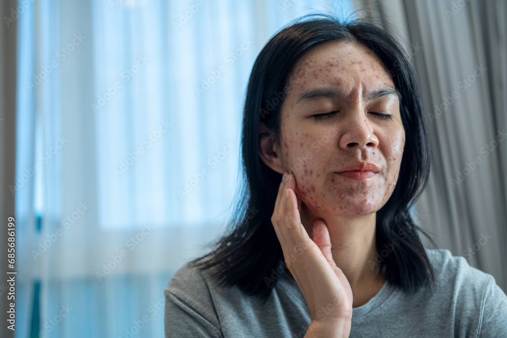 Acne on face because the disorders of sebaceous glands productions. Acne or a Cosmetic Allergy. Hormonal changes and Foods Cause Symptoms of Skin Allergies Acne on face because the disorders of sebaceous glands productions. Acne or a Cosmetic Allergy. Hormonal changes and Foods Cause Symptoms of Skin Allergies