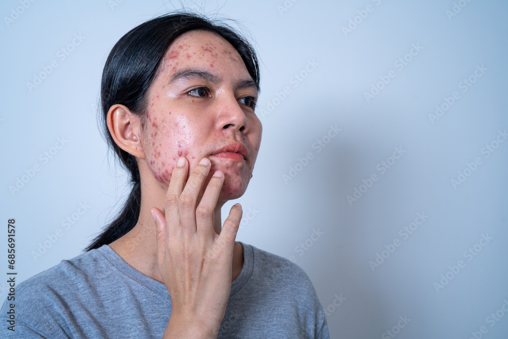 Acne on face because the disorders of sebaceous glands productions