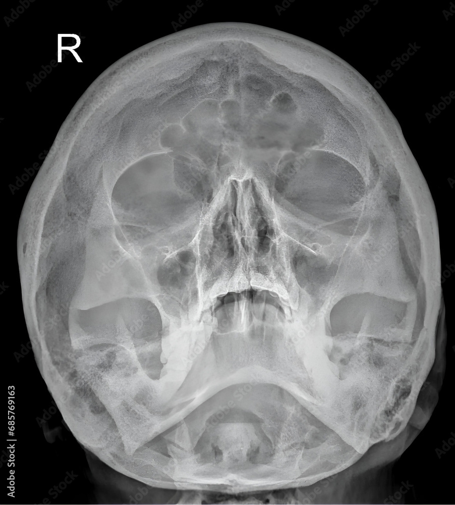 A sinus X-ray, also known as a paranasal sinus X-ray, provides images ...