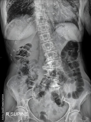 Canvastavla This X-ray captures the abdominal region, revealing signs indicative of a bowel obstruction