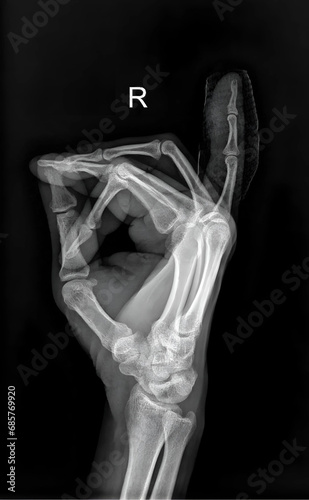  X-ray of the hand showcases the trauma.