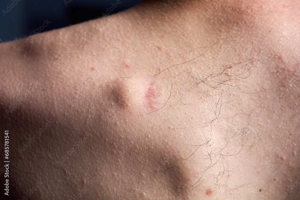 Small round lipoma on the upper back of young caucasian man. The lipoma is next to the scar left by a previous lipoma that became infected and dissolved