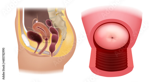  Cervix uteri anatomy. The cervix is the lower narrower portion of the uterus. Diagram of the uterus and part of the vagina. The human female reproductive system.