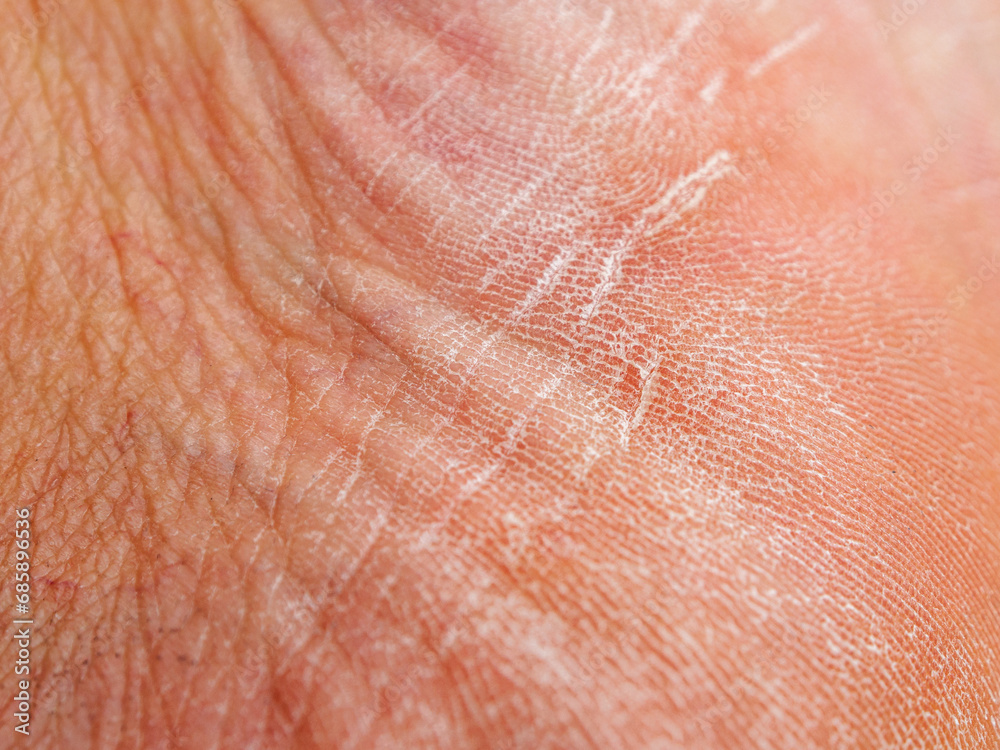 Dry skin damaged macro shot of the surface Dry skin damaged macro shot of the surface