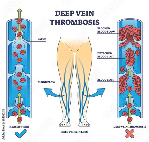 Deep vein thrombosis condition with blood clot blockage outline diagram. Labeled educational comparison with healthy vein and dangerous flow vector illustration. Cardiovascular disease explanation. photo