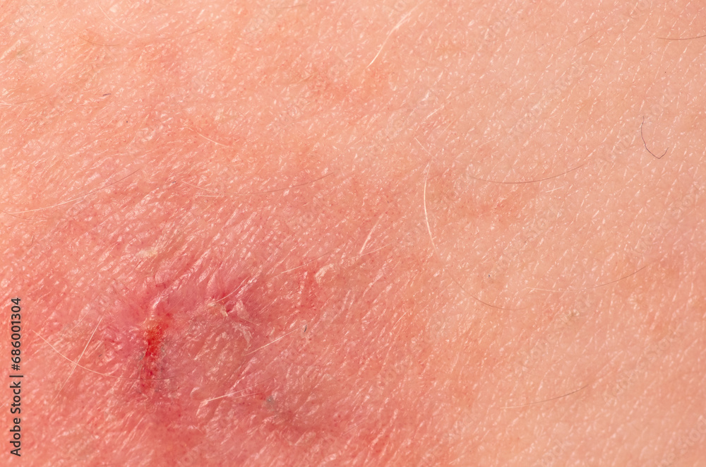 Fototapeta premium Close-up of a wound on the skin. Macro