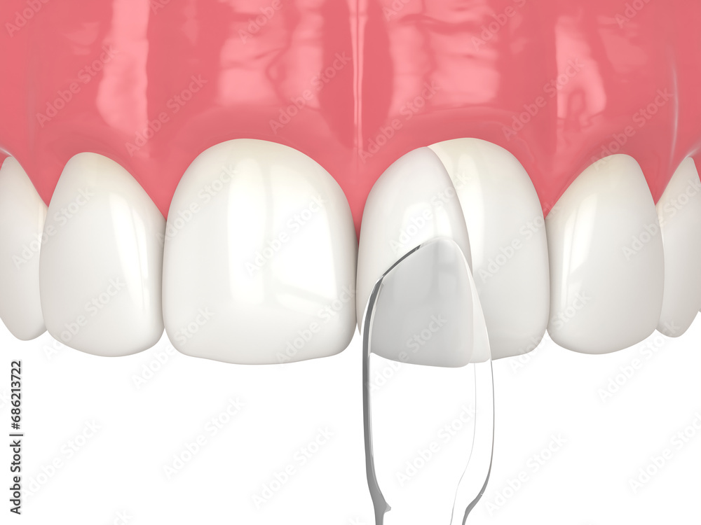 3d render of tooth reshaped by composite resin adm matrix over white. - obrazy, fototapety, plakaty 