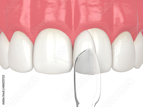 3d render of tooth reshaped by composite resin adm matrix over white. photo