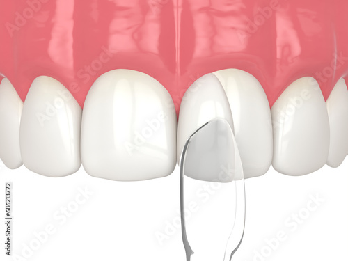 3d render of tooth reshaped by composite resin adm matrix over white.