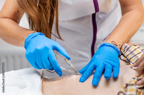 Nurse removing surgical stitches from the abdomen of a patient following surgical intervention. High quality photo