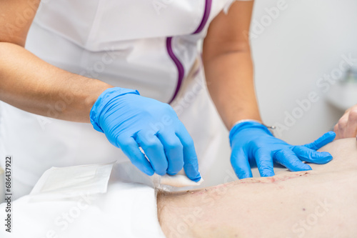 hand of Doctor is using clean cotton dressing infection wound at a man abdomen. Bandage for wound dressing at a clinic. medical care healthcare insurance concept. High quality photo