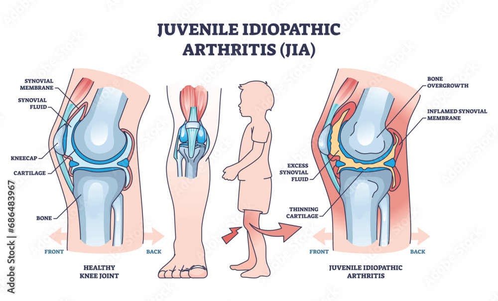 Juvenile idiopathic arthritis or JIA anatomical explanation outline diagram. Labeled educational medical scheme with healthy and diseased joint comparison vector illustration. Child bone illness. - obrazy, fototapety, plakaty 
