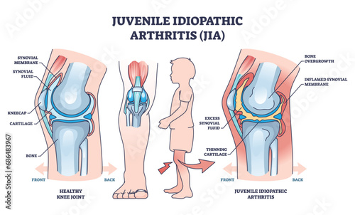 Juvenile idiopathic arthritis or JIA anatomical explanation outline diagram. Labeled educational medical scheme with healthy and diseased joint comparison vector illustration. Child bone illness. photo