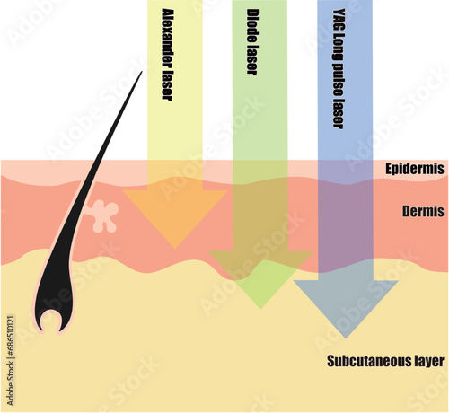 肌断面図で見る脱毛レーザーの違い